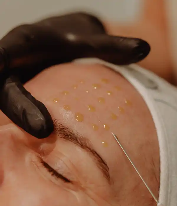 BioRePeelCl3 peeling behandeling bij Maison de Beauté