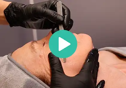 Video van dermaplaning behandeling