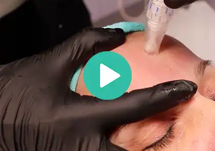 Video van SkinPen medische microneedling behandeling